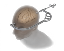 Caroline Guide with Head Stratasys 3D Printing | Medical Innovation